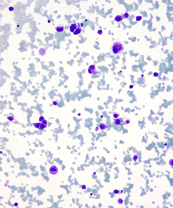 03 : Bone Soft Tissue Epithelioid Sarcoma