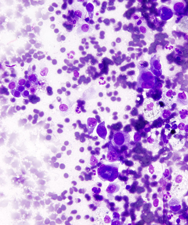 04 : Bone Soft Tissue Epithelioid Sarcoma