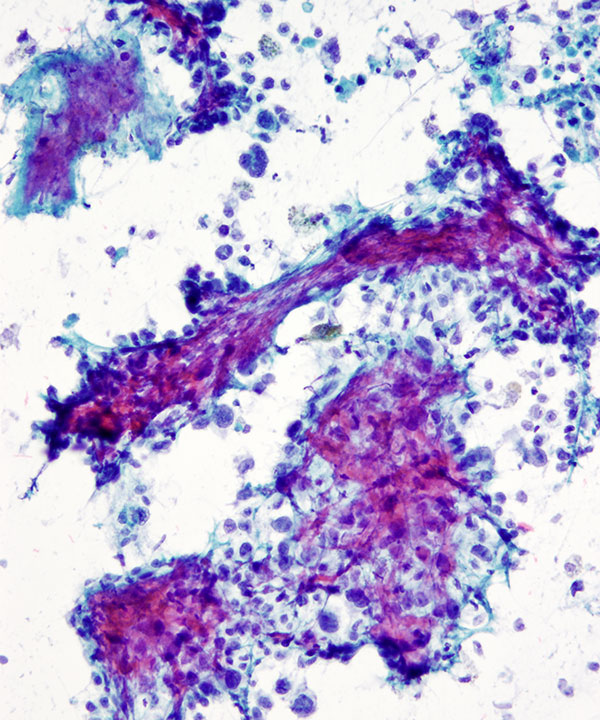 06 : Bone Soft Tissue Epithelioid Sarcoma