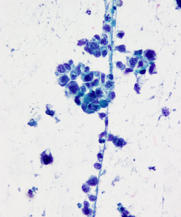 08 : Bone Soft Tissue Epithelioid Sarcoma