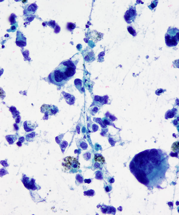 09 : Bone Soft Tissue Epithelioid Sarcoma