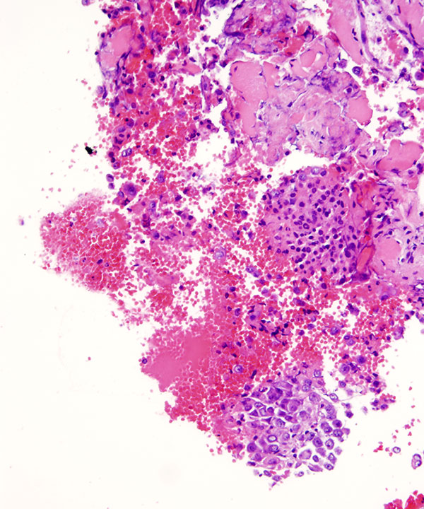 10 : Bone Soft Tissue Epithelioid Sarcoma