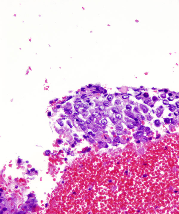 image showing 'Epithelioid Sarcoma'