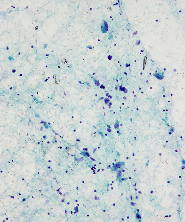 02 : BoneSoft Tissue Granular Cell Tumor