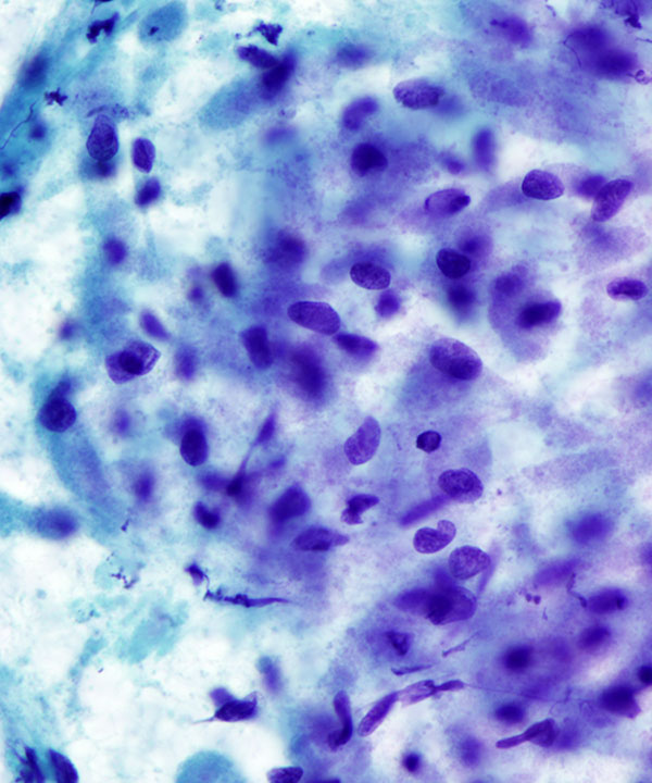 03 : BoneSoft Tissue Granular Cell Tumor