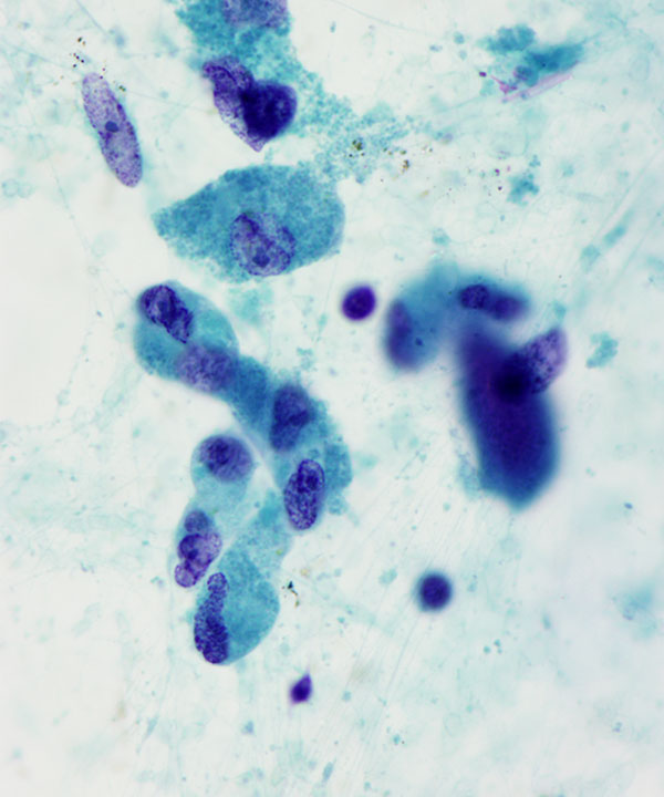04 : BoneSoft Tissue Granular Cell Tumor