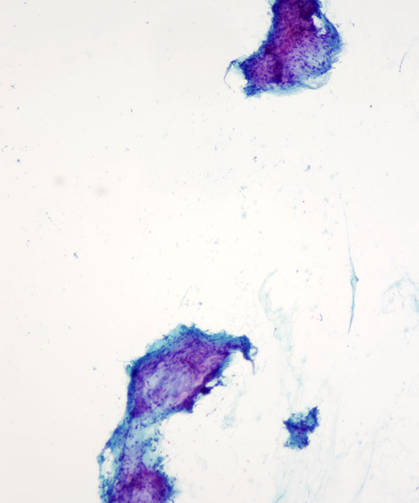 image showing 'Hemangioma'