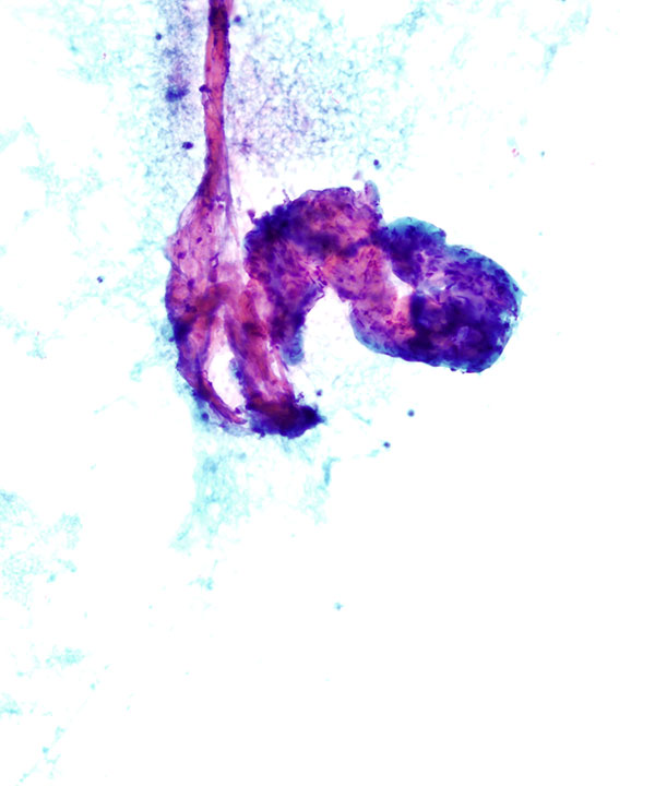 02 : Bone & Soft Tissue Hemangioma