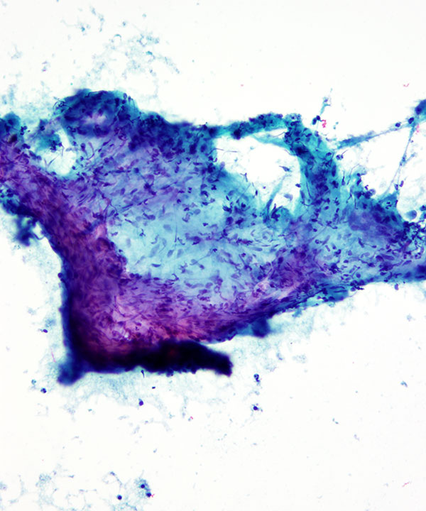 04 : Bone & Soft Tissue Hemangioma