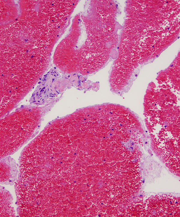 06 : Bone & Soft Tissue Hemangioma
