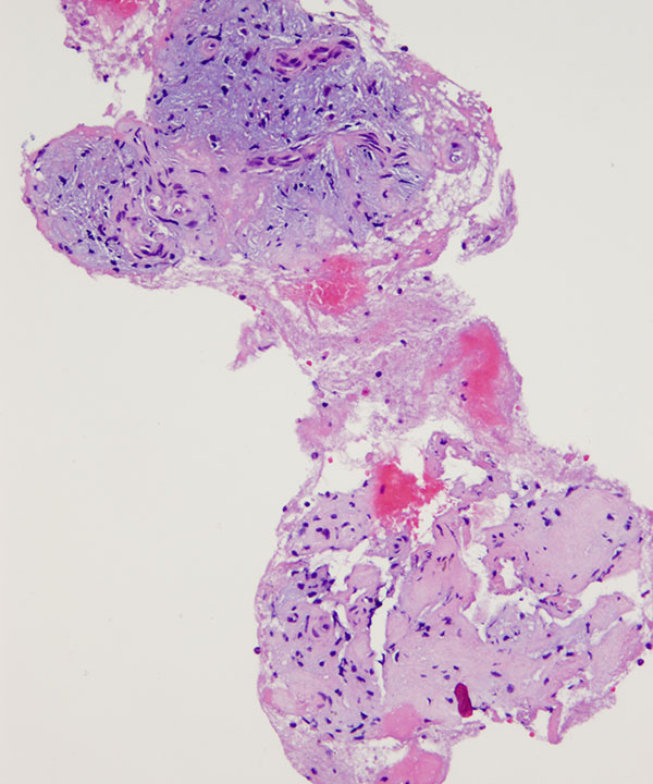 07 : Bone & Soft Tissue Hemangioma