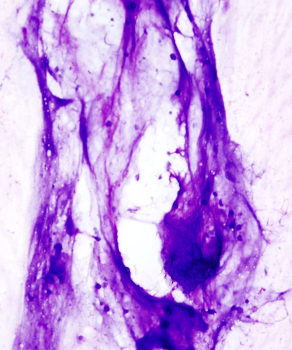 02 : Bone Soft Tissue Osteochondroma