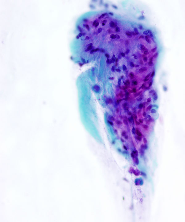 06 : Bone Soft Tissue Osteochondroma