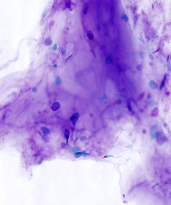 07 : Bone Soft Tissue Osteochondroma