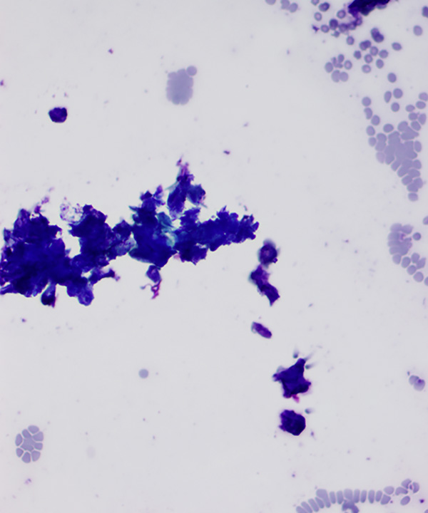 image showing 'Pilomatrixoma'