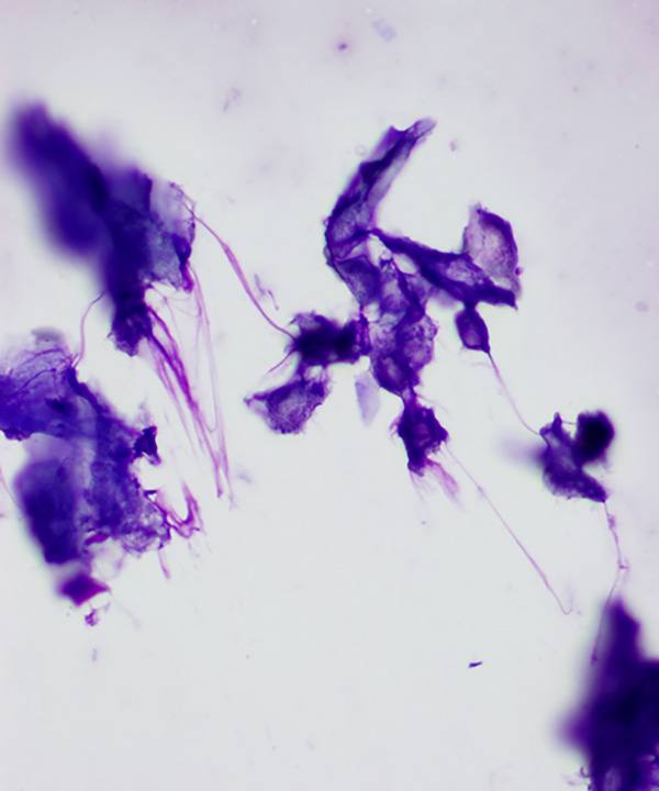 02 : Bone  Soft Tissue Pilomatrixoma