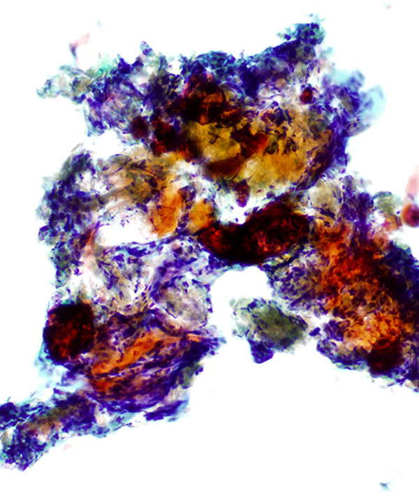 03 : Bone  Soft Tissue Pilomatrixoma