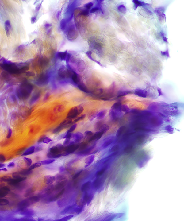 04 : Bone  Soft Tissue Pilomatrixoma