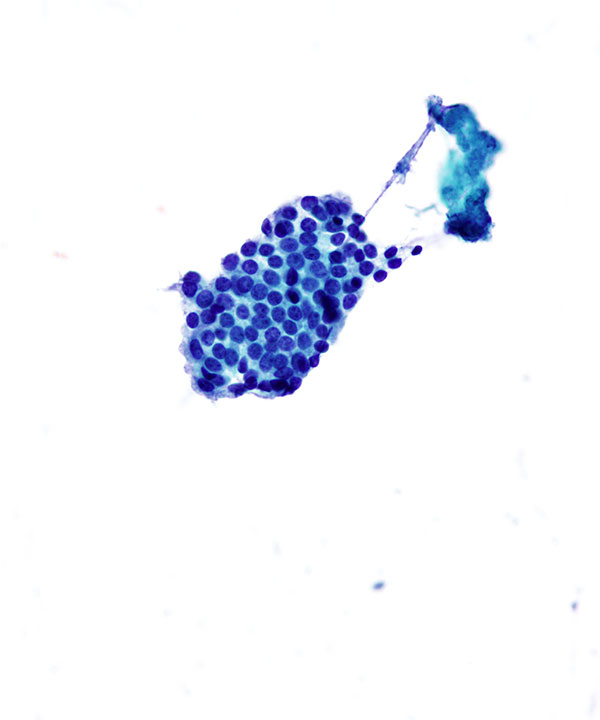 5 : Breast Benign Ductal Cells