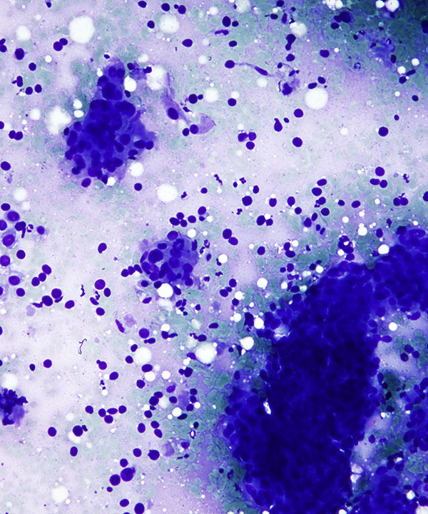 image showing 'Ductal Carcinoma'