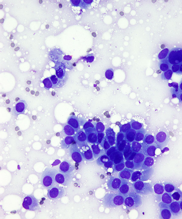 2 : Breast Ductal Carcinoma