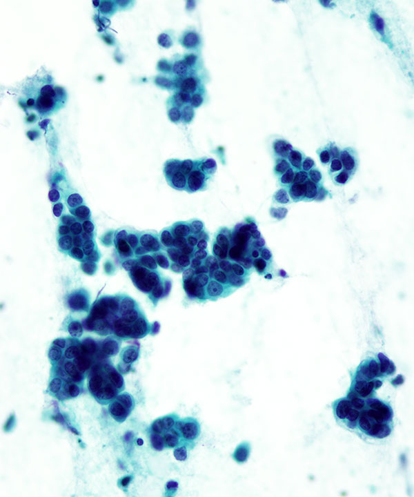 3 : Breast Ductal Carcinoma