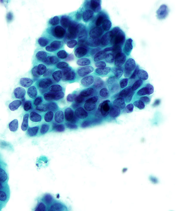 4 : Breast Ductal Carcinoma