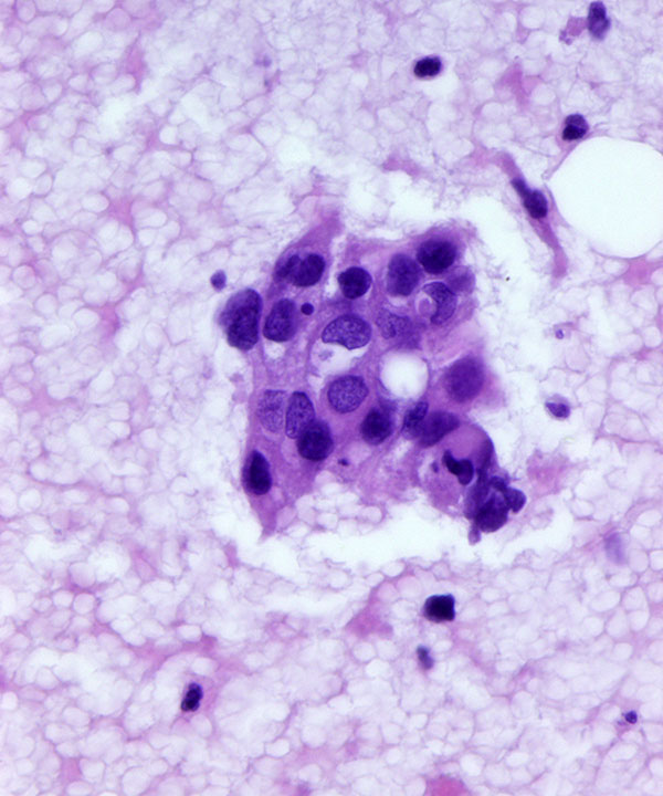 6 : Breast Ductal Carcinoma