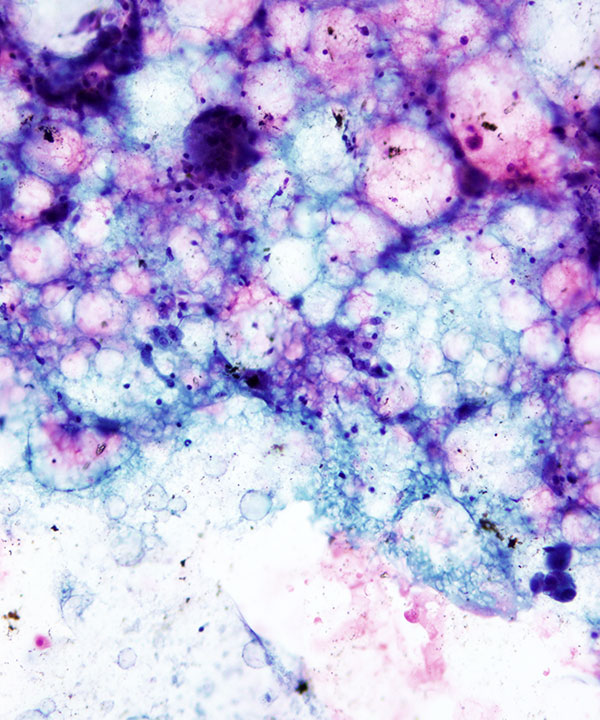 image showing 'Fat Necrosis'