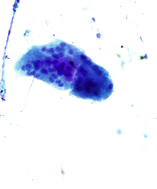 3 : Breast Fat Necrosis
