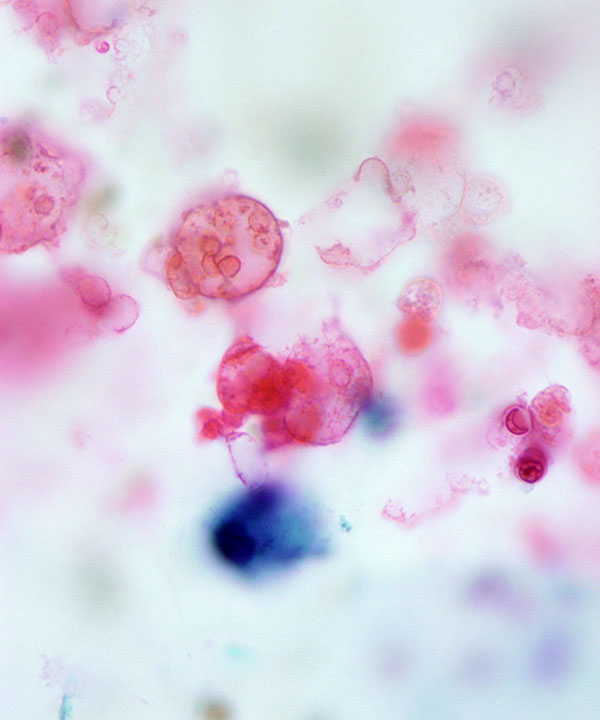 5 : Breast Fat Necrosis