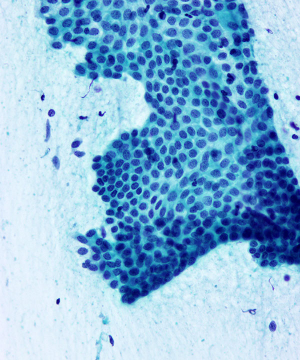 4 : Breast Fibroadenoma