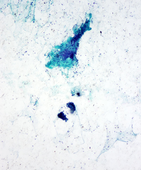 5 : Breast Fibroadenoma