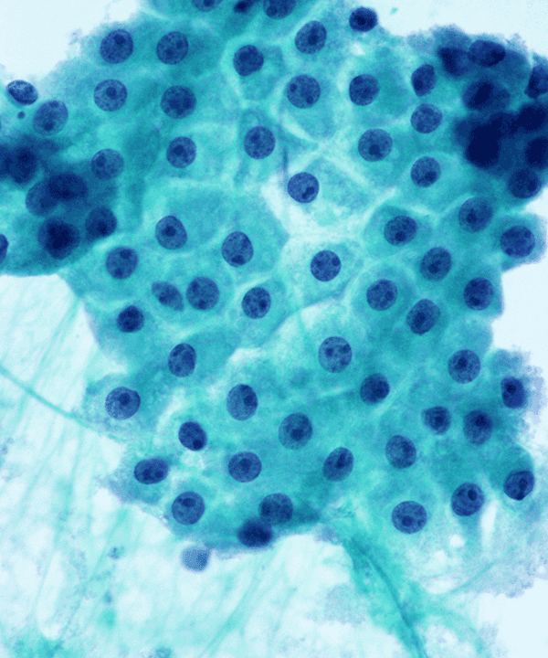 05 : Breast Fibrocystic Change