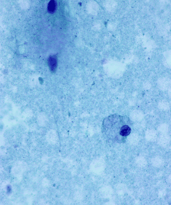 06 : Breast Fibrocystic Change