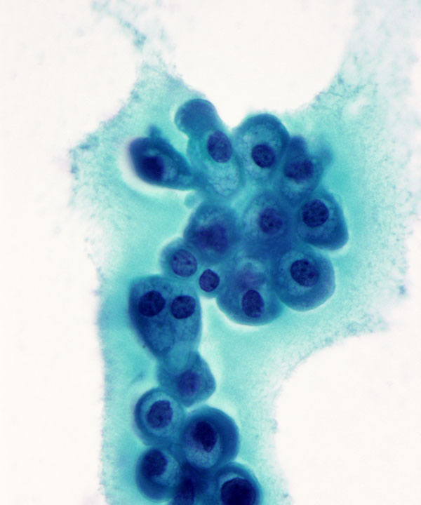 04 : Breast Fibrocystic Change