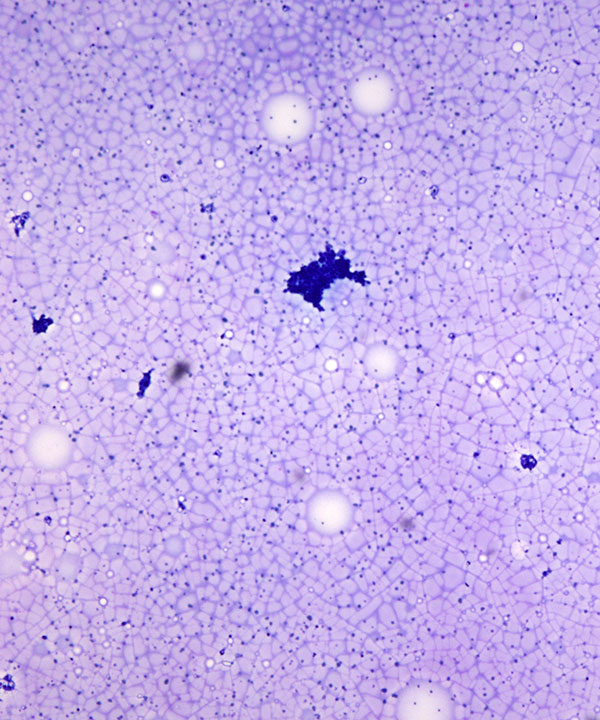 image showing 'Fibrocystic Change'