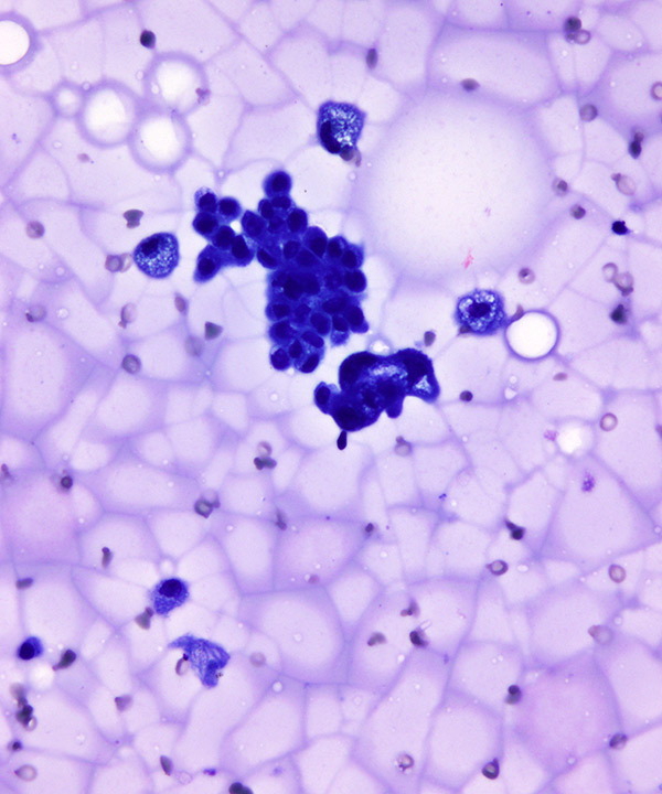 02 : Breast Fibrocystic Change