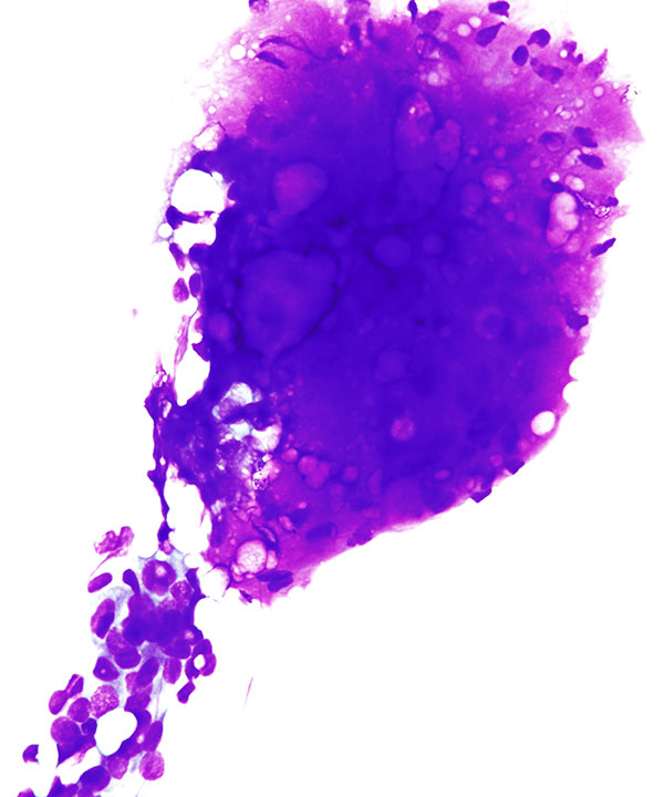 02 : Breast Fibroepithelial Lesion