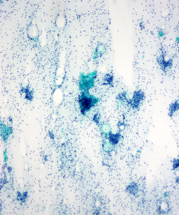 04 : Breast Fibroepithelial Lesion