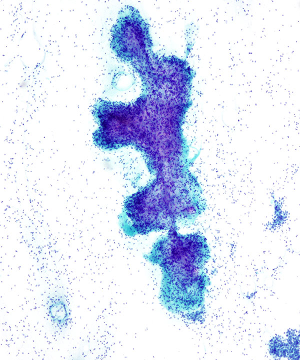 05 : Breast Fibroepithelial Lesion
