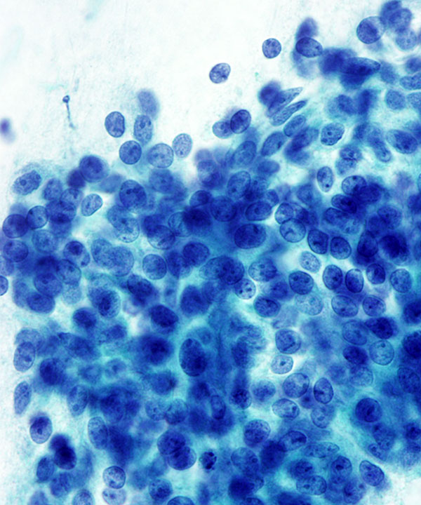 08 : Breast Fibroepithelial Lesion