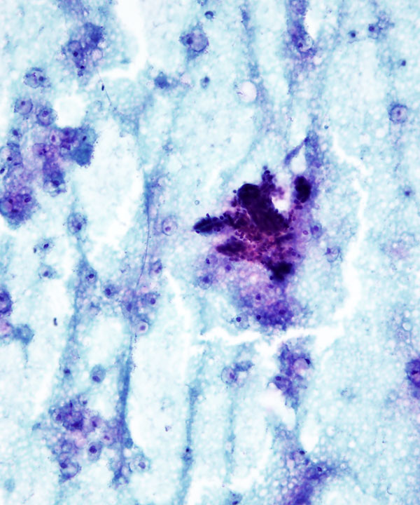 image showing 'Galactocele'