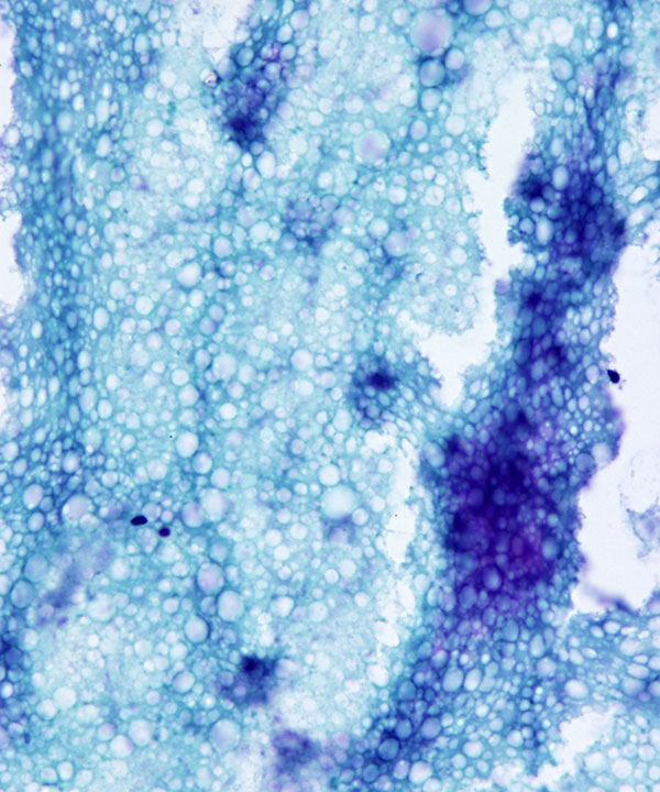 04 : Breast Galactocele