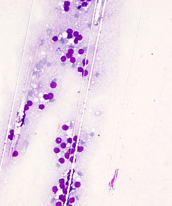 image showing 'Lactational Adenoma'