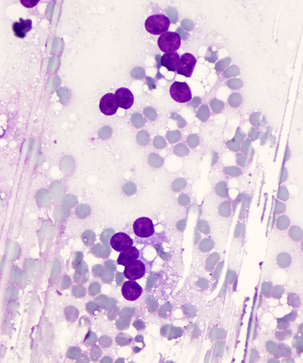02 : Breast Lactational Adenoma