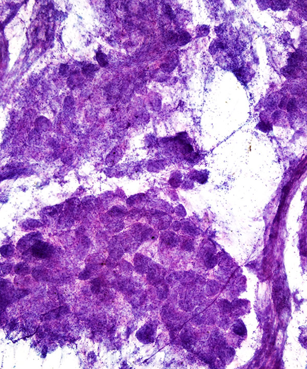 03 : Breast Lactational Adenoma