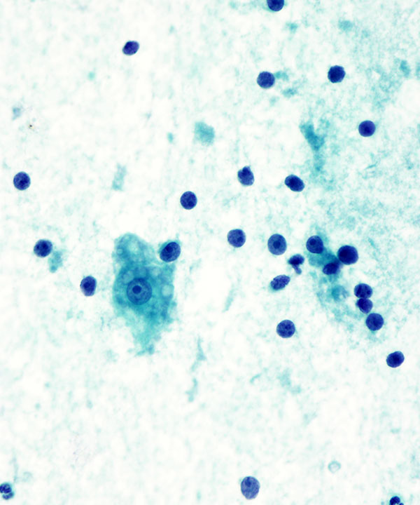 07 : Breast Lactational Adenoma