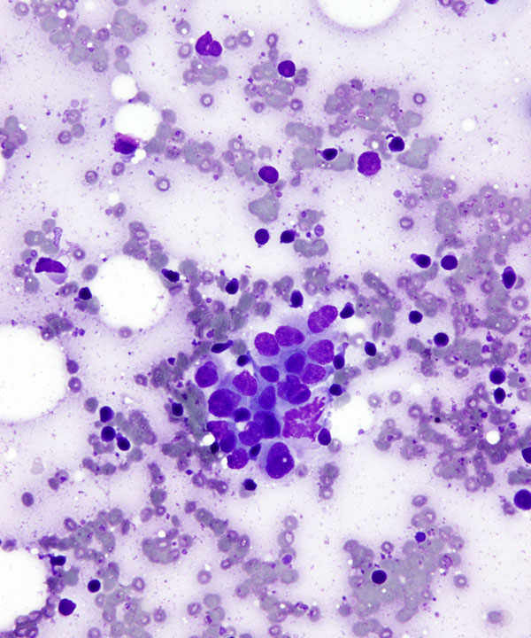 image showing 'Lobular Carcinoma'