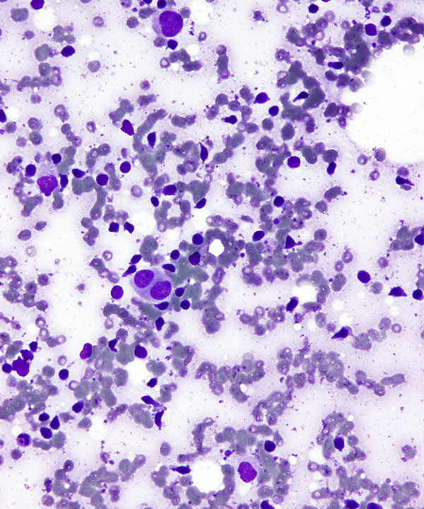 2 : Breast Lobular Carcinoma